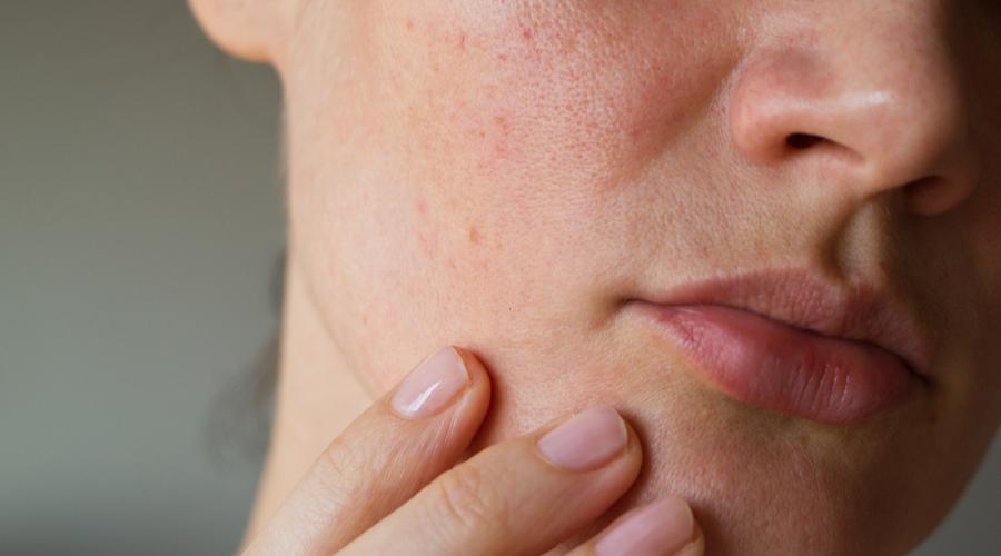 Guess I Have Dry Skin Now— Here’s How to Treat It